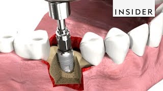 How Dentists Insert Dental Implants [upl. by Nnaaihtnyc]