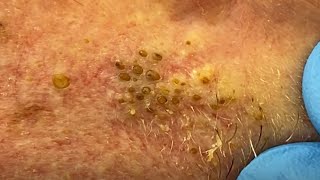 Extreme Blackhead Extraction Summer Throwback  CONTOUR DERMATOLOGY [upl. by Acinej231]