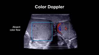 Development of inguinal Canal [upl. by Gurney]