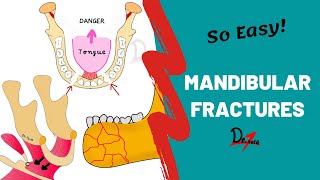 Mandibular Fractures  Basics  DENTAL NOTES [upl. by Karita]