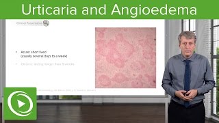 Urticaria Hives and Angioedema – Pediatrics  Lecturio [upl. by Fish]