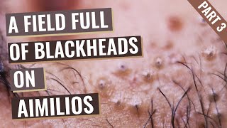 Field Full of Blackheads on Aimilios’s Nose and Around The Lips  Part 3 out of 4 [upl. by Nilerual]