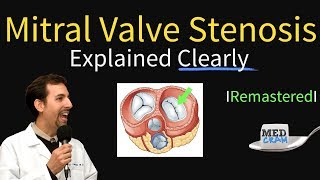 Mitral Valve Stenosis Diagnosis Treatment Pathophysiology [upl. by Trotta]