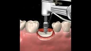 Step by step dental implant surgery Gary R OBrien DDS [upl. by Thorlie]