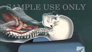 Cervical Chiropractic Adjustment [upl. by Ecirehc]