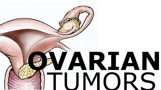 Ovarian Pathology amp Tumors [upl. by Girhiny452]