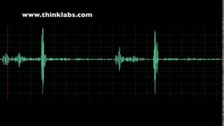 Aortic Regurgitation and Mild Stenosis [upl. by Aneej766]