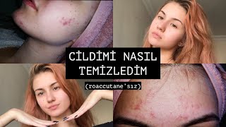 SİVİLCELERİMDEN NASIL KURTULDUM ✨ roaccutane’sız [upl. by Iadrahc]