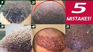 These 3 Things Are Normal After A Hair Transplant [upl. by Drye]