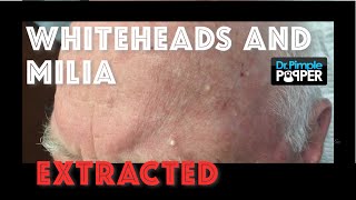 Whiteheads and milia extracted after Mohs surgery [upl. by Alleuqcaj]