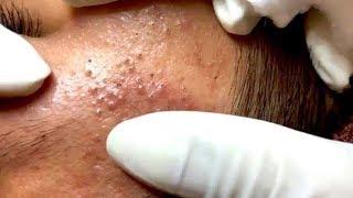 How To Remove Blackheads And Whiteheads On Face Easy 72 ✦ Dr Laelia ✦ [upl. by Ailuy]