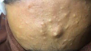 How to Remove Blackheads And Whiteheads On Face Easy ✦ Acne Treatment ✦ [upl. by Turk182]