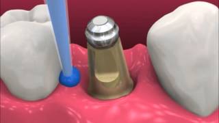 Smyl Manatee  Dental Implant Procedure [upl. by Kurtz]