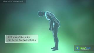 Kyphosis Symptoms [upl. by Annabelle926]