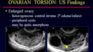 What You Need to Know About Ovarian Cysts [upl. by Nnyleuqaj23]