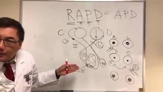 RAPD Relative Afferent Pupillary Defect MarcusGunn pupil [upl. by Alyosha367]