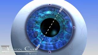 Alcon Toric Lens at Vision Care of Maine [upl. by Ranzini]