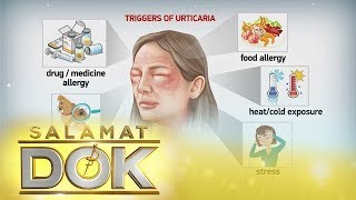 Salamat Dok Causes and symptoms of urticaria [upl. by Leola]