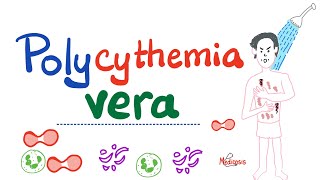 Polycythemia Vera PV  Myeloproliferative Neoplasm MPN  Erythrocytosis  Hematology [upl. by Carmelia]