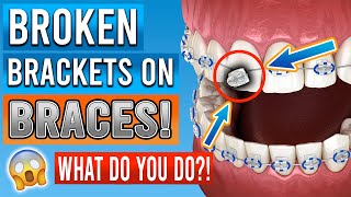 Broken Braces Brackets What You Need To Know [upl. by Lurlene]