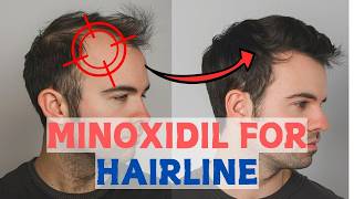 Minoxidil for Frontal Baldness  Restore Your Hairline [upl. by Ahsinal]