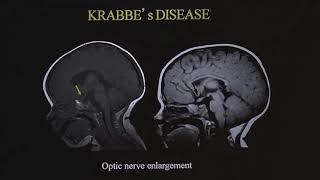 TMT Neuroradiology by Dr Deepak Patkar Ped White Matter Diseases  II [upl. by Bovill]