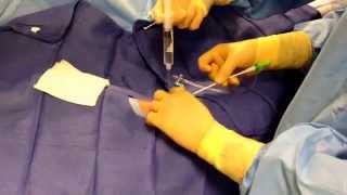 Tunneled Dialysis Catheter Alan B Lumsden MD Philip Auyang MD [upl. by Haydon]