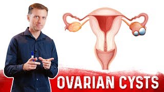 OVARIAN CYST  CAUSES SYMPTOMS amp TREATMENT [upl. by Sturges132]