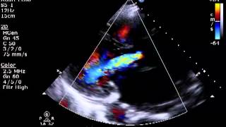 Aortic amp Mitral Regurgitation [upl. by Nagram]