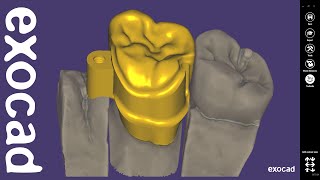 exocad Quick Guide New Attachment Feature [upl. by Goldberg]