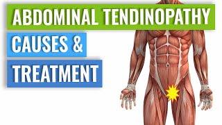 Abdominal Tendinopathy  Causes and Treatment Including Exercises [upl. by Wendin]