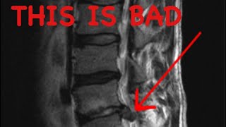 How to Read a Spine MRI [upl. by Harriet]