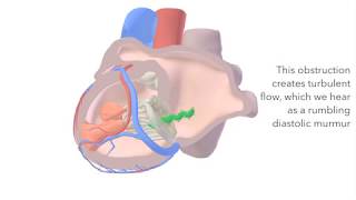 Mitral Stenosis  sound amp animation [upl. by Zetnas428]