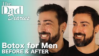 Botox For Men  Before amp After  The Dad Diaries [upl. by Ecinhoj]