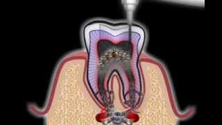 Wurzelbehandlung beim Zahnarzt [upl. by Atisusej]