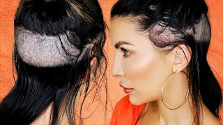 Hair Transplant Forehead Reduction Procedure for Traction Alopecia  Dr Matt Huebner Mela [upl. by Llehcal]