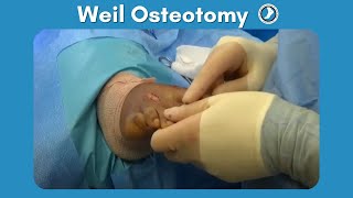 Dr Trevor Williams  Evans Calcaneal Osteotomy  CONMED Surgical Technique [upl. by Nguyen210]