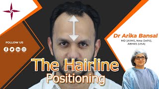 How To Determine The Right Hairline Positioning By Dr Arika Bansal At EugenixHairSciencesofficial [upl. by Eerihs]