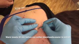 Blackheads back removal  the Australian Anaconda [upl. by Deanne770]