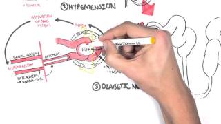 Chronic Kidney Disease CKD Pathophysiology [upl. by Rakel190]