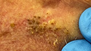 Extremely Clogged Pores Extracted  Contour Dermatology [upl. by Ninnette208]