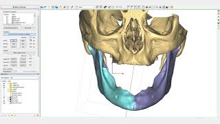 Mandible Reconstruction Tutorial  PROPLAN CMF™ [upl. by Eitnom38]