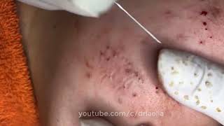 How To Remove Blackheads And Whiteheads On Face Easy 116 ✦ Dr Laelia ✦ [upl. by Nilkcaj381]