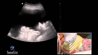 How To Ultrasound Guided Paracentesis Procedure 3D Video [upl. by Wolk]