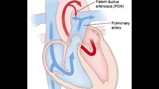 Patent Ductus Arteriosus [upl. by Neehar]