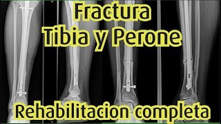 Fractura Tibia y Perone  Rehabilitacion completa [upl. by Annaoy416]