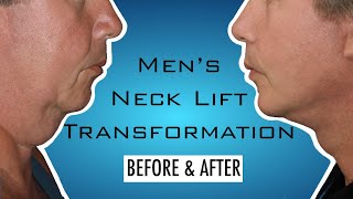 Male Plastic Surgery Transformations  Seoul Guide Medical [upl. by Bille]