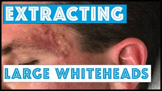 Acne Vulgaris and Extracting large Whiteheads  Part 1 [upl. by Idel732]