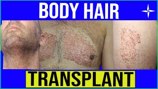 I Got A Hair Transplant  My Emotional Female Hair Transplant Surgery Experience [upl. by Malorie]