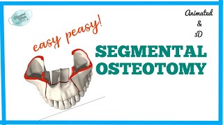 SEGMENTAL OSTEOTOMY  MAXILLARY OSTEOTOMY [upl. by Suoivatco]